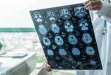 اجراءات طبية سريعة يجب اعتمادها عند حدوث الجلطة الدماغية